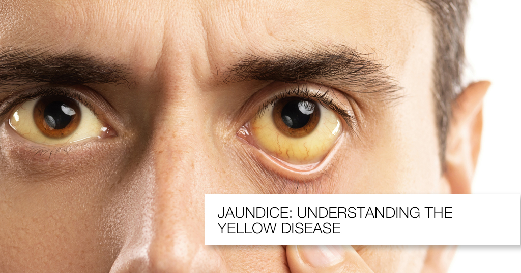 Understanding Jaundice: Symptoms and Treatment