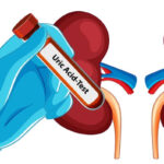 Uric Acid: Causes, Symptoms and Treatment