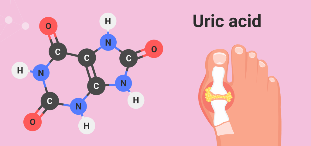 Uric Acid: Causes, Symptoms and Treatment Uric Acid: Causes, Symptoms and Treatment