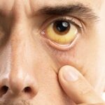 Supporting Liver Health: Home remedies and diet tips for Jaundice