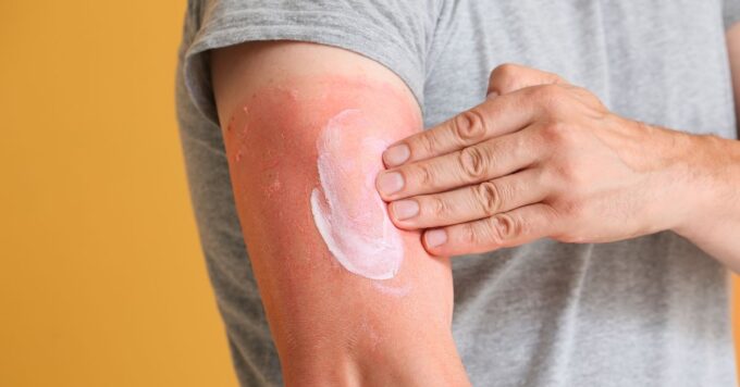 Beat the Heat: How to Keep Your Skin Hydrated and Sunburn-Free This Summer